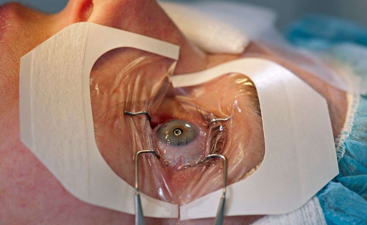 eye surgery